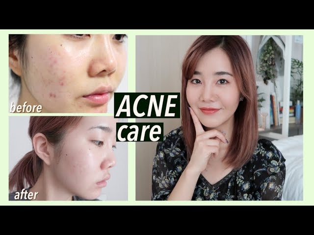 How to Use Korean Skincare for Acne Scars and Hyperpigmentation -  Get Rid of Dark Spots