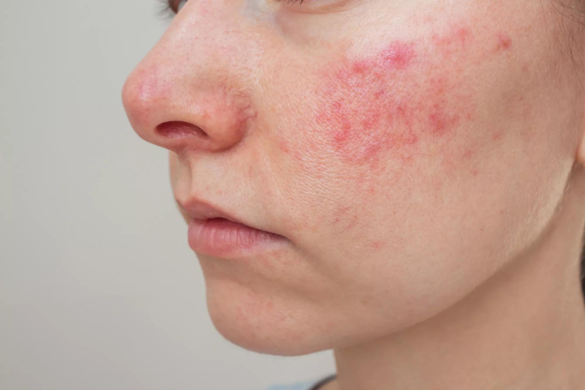 Using Face Oil for Rosacea: Tips for Happy Skin.