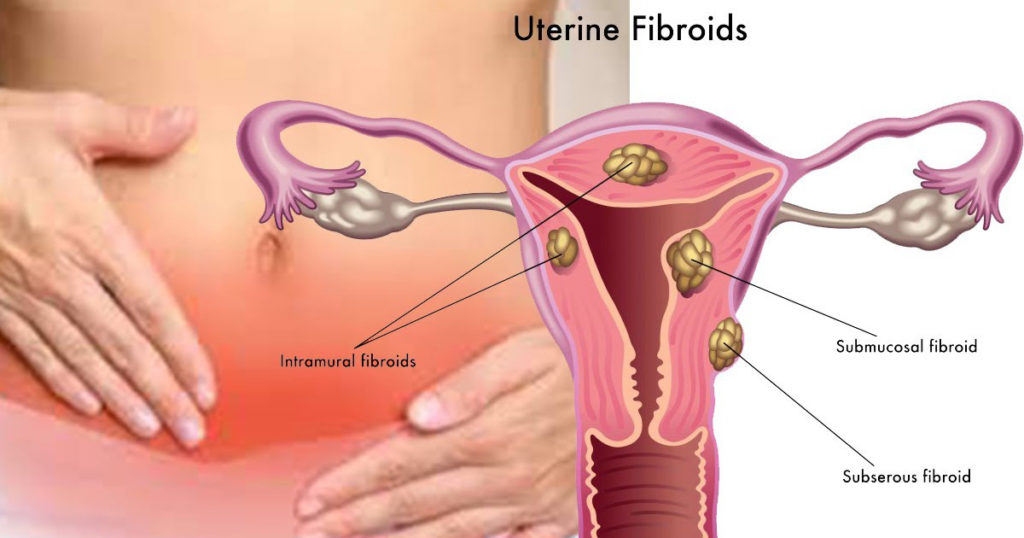 Fibroids: Can Sperm Cause Fibroids to Grow? Separating Myth from Fact for You!