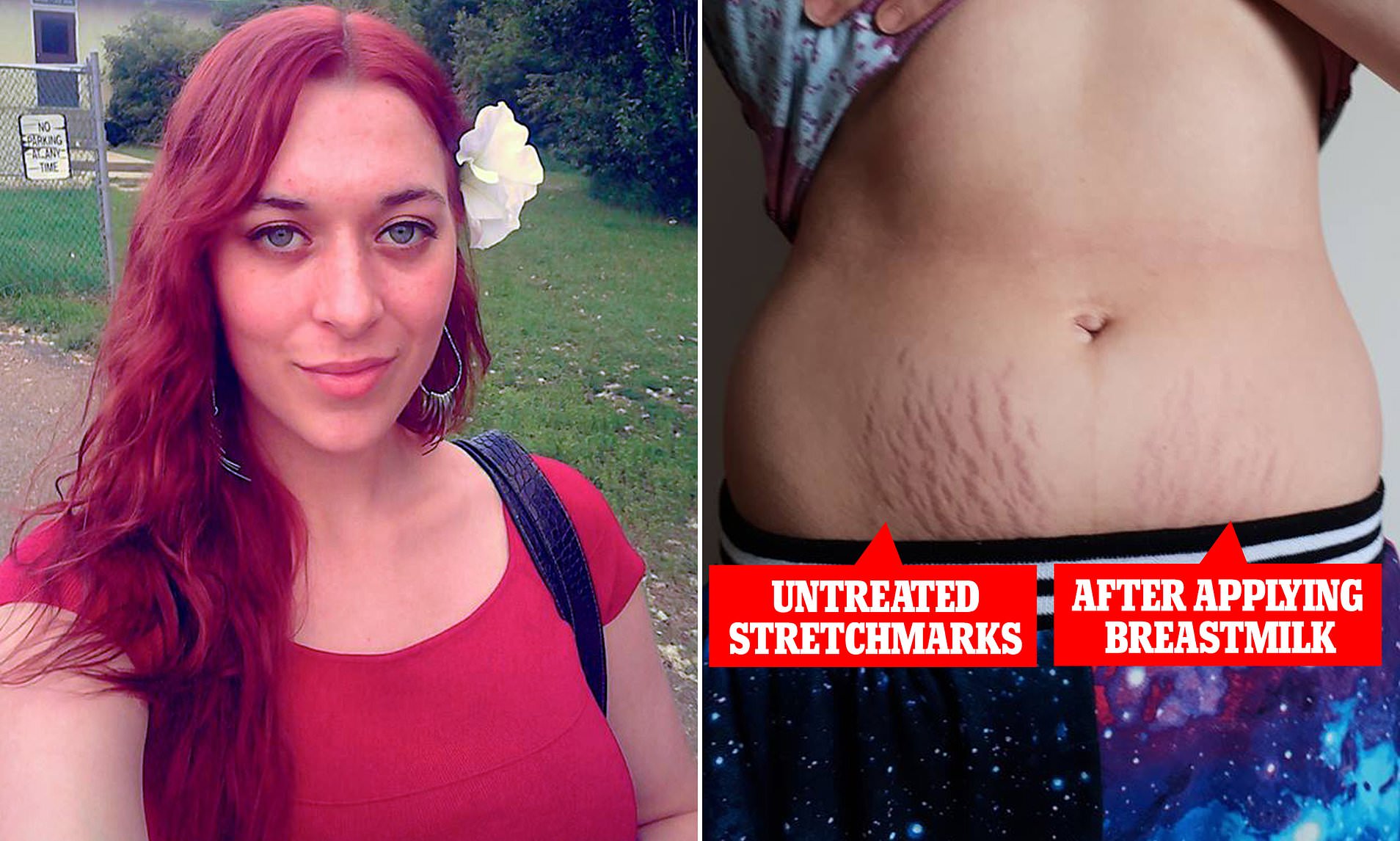 Want to Reduce Stretch Marks with Breast Milk? Read This