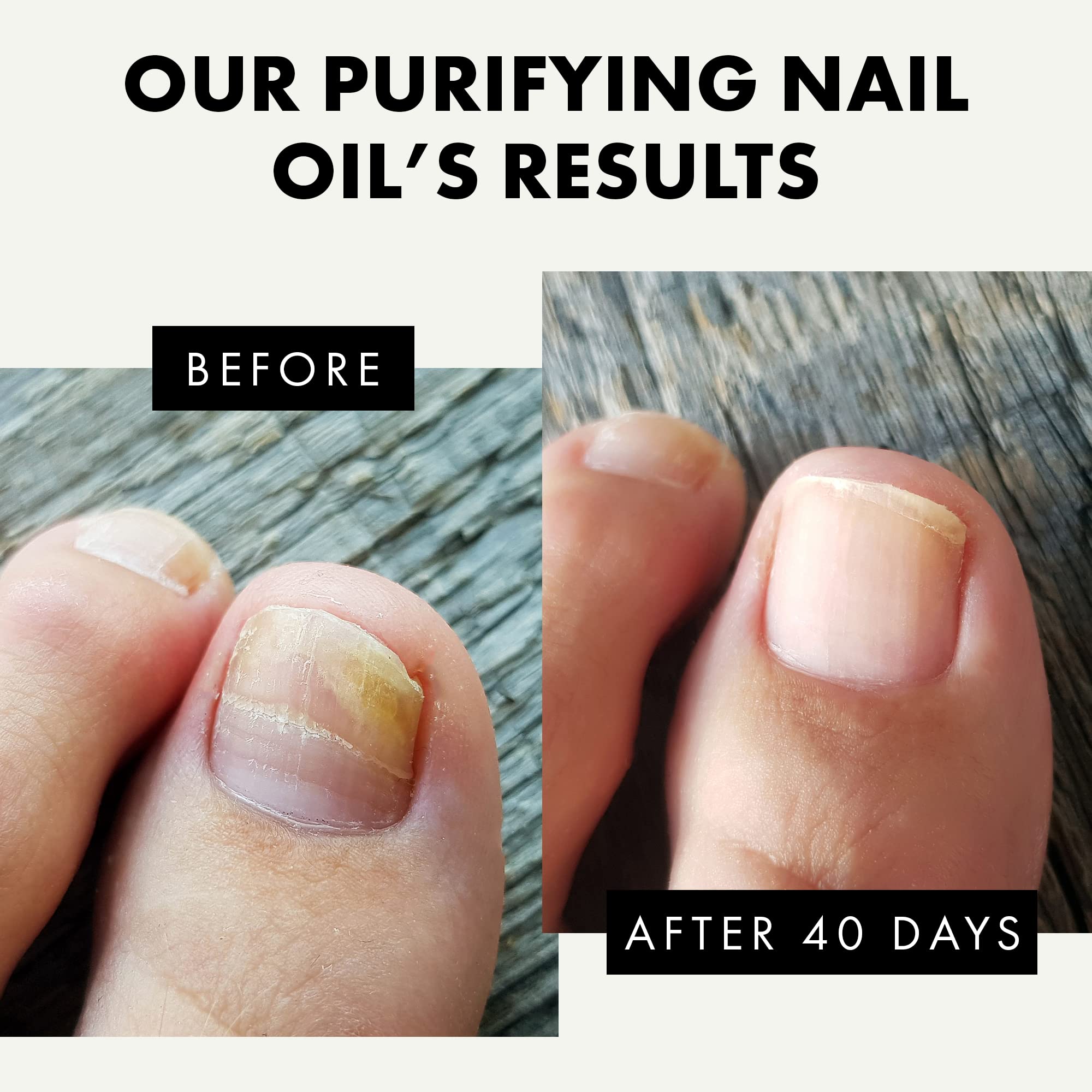 Castor Oil for Nail Fungus Before and After Real Results