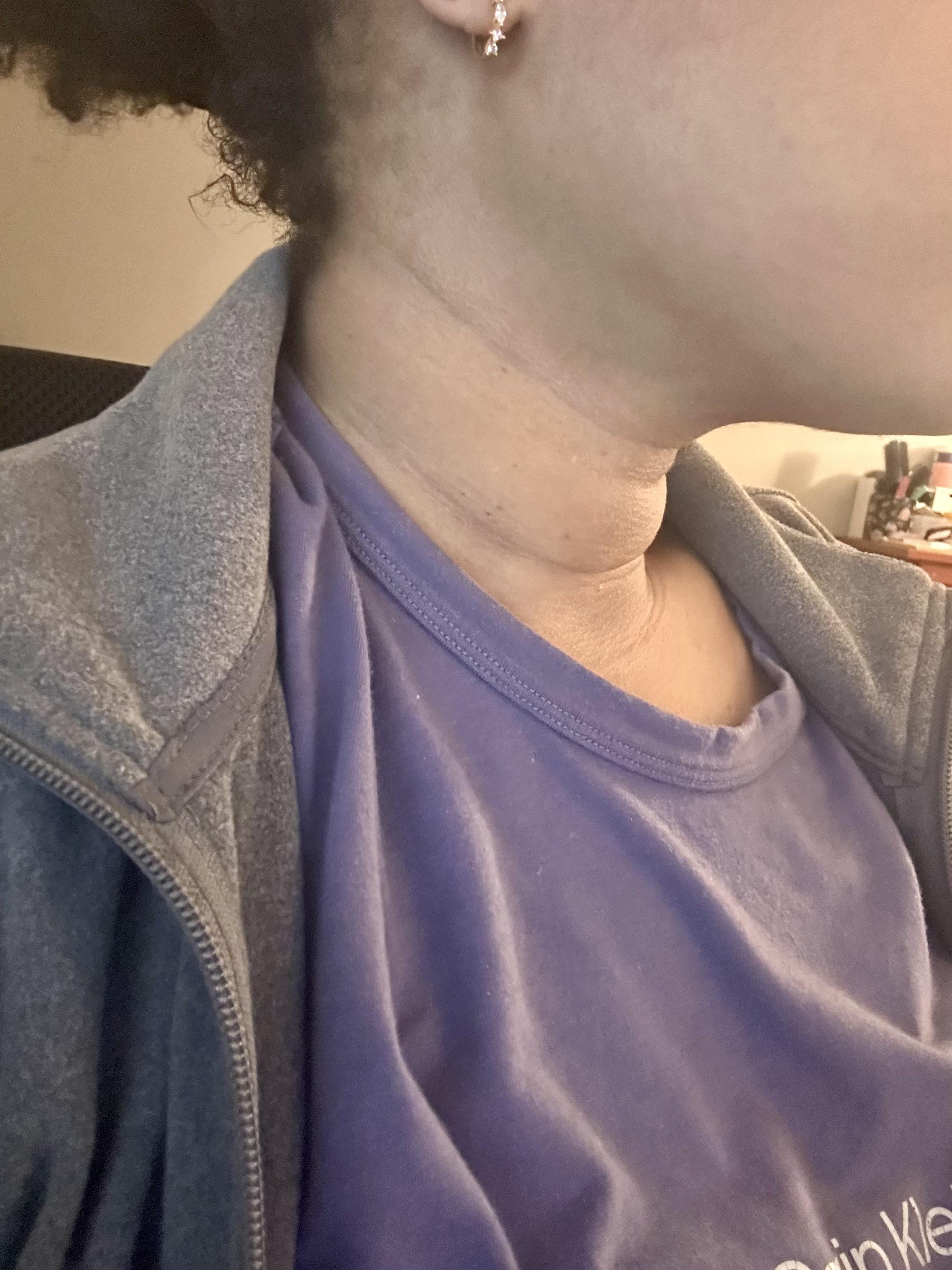 Fat Lines on Neck: What Causes Them and How to Reduce Their Appearance