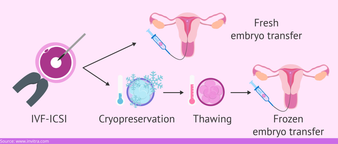 Frozen Embryo Transfer After Polyp Removal: Is It Safe? A Simple Guide for You