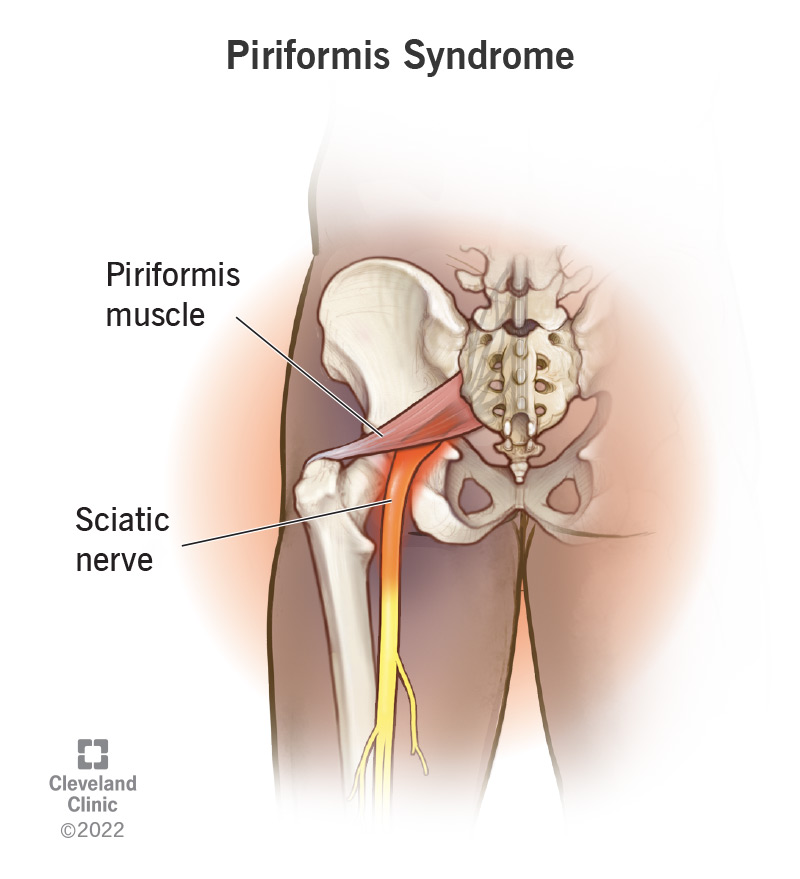 Piriformis Syndrome Recovery Time: Factors That Affect Healing and What You Can Do