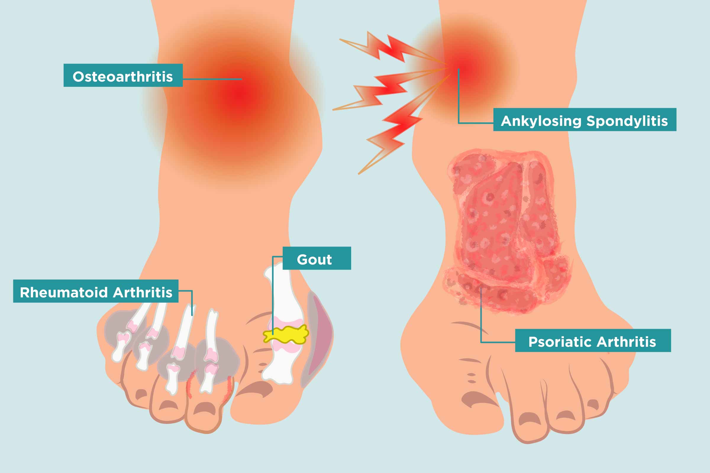 Stop Aching Stiff Feet in the Morning!  Try These Quick and Easy Solutions.