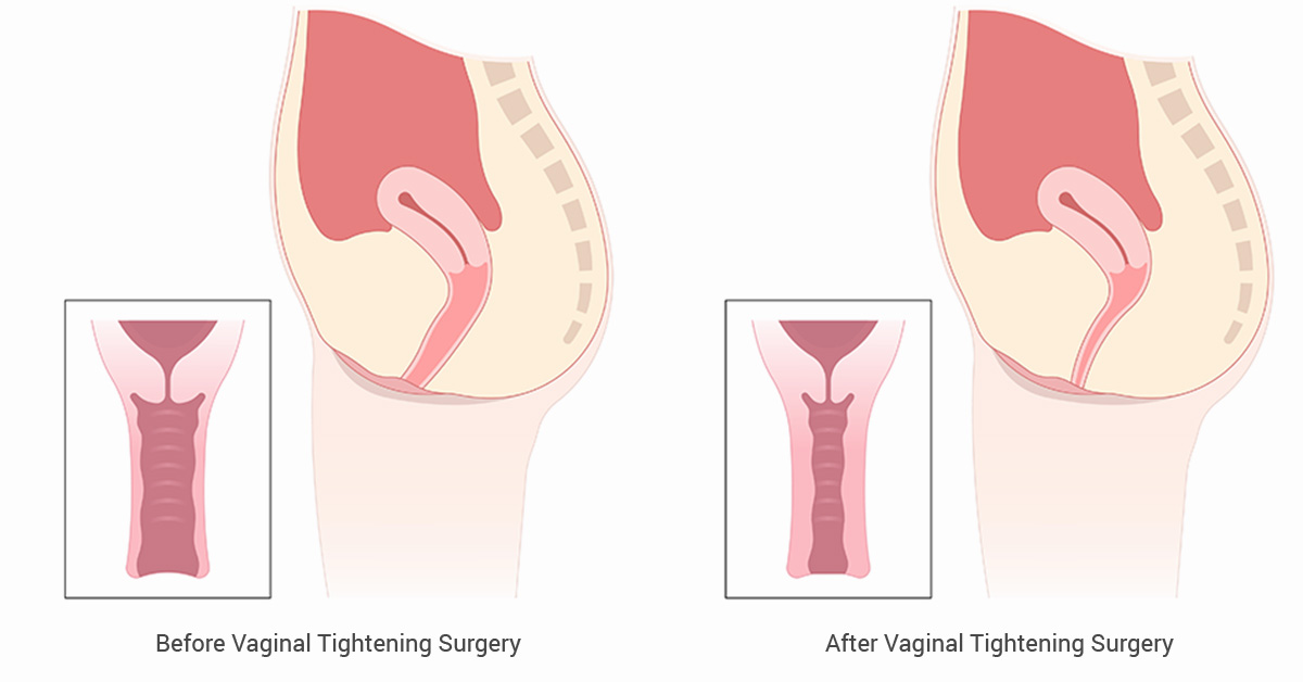 How to tighten your vagina after birth: A step-by-step guide