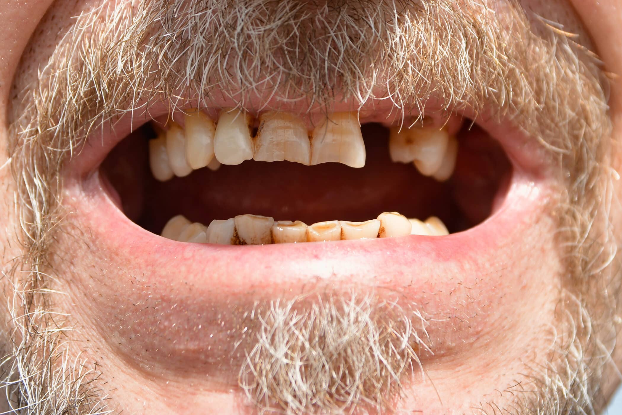 Why Do Teeth Fall Out in Adults? Dont Panic, Heres What You Need to Know