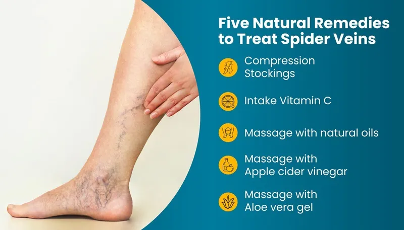 Castor Oil Spider Veins Treatment: Easy Home Remedy to Try Now