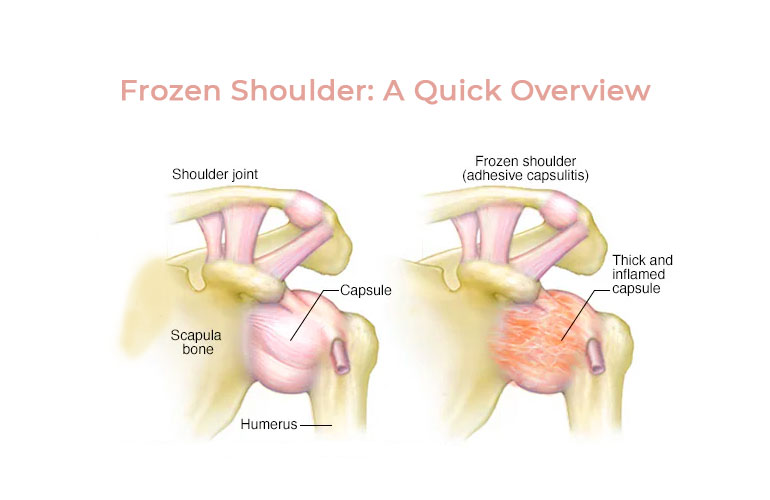 Understanding Frozen Shoulder: How Estrogen Levels Might Play a Role